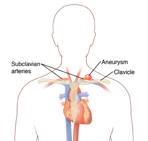 Outline of head and chest showing heart, arteries, clavicle, and subclavian aneurysm.