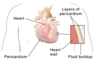 Front view of chest showing heart with inset showing pericardial effusion.
