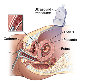 Side view of female pelvis showing transcervical chorionic villus sampling.