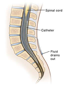 Side view cross section of lower spine showing catheter inserted into spinal space to drain fluid.