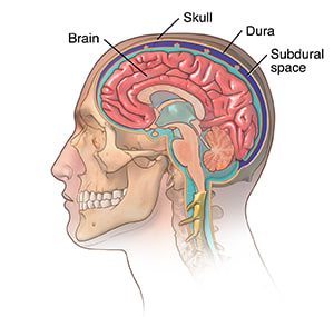 Cross section of brain in head, showing layers  of skull, dura, and subdural space that protects brain.