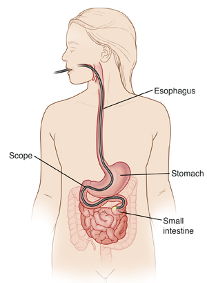 Head and torso showing scope placed in mouth, esophagus, stomach, and past duodenum into small intestine.