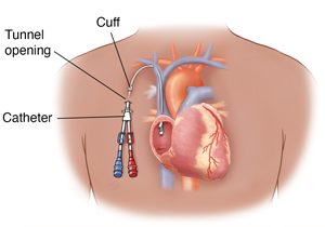 Person's chest showing a tunneled catheter entering right atrium of heart. 