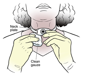 Person cleaning skin around tracheostomy tube in neck.