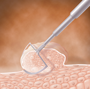 Closeup of skin showing instrument removing wart.