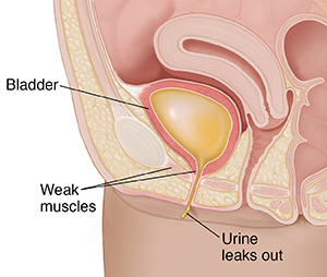 Close-up cross section of female urinary tract, showing bladder weak muscles letting urine leak out.