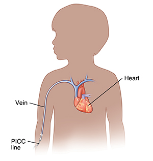 Outline of child showing PICC line inserted into vein.