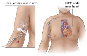 PICC placed in arm just above the elbow connects to veins near the heart.