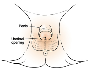 External genitals of male child, showing urethral opening on penis.