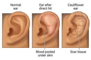 Normal external ear compared to ear with swelling on the upper external ear. After scar tissue forms, the same ear looks lumpy throughout the external ear.