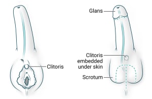 New, longer urethra is connected to shaft. Glans is created with urethral opening at the top. Existing clitoris is embedded under skin and scrotum is created.